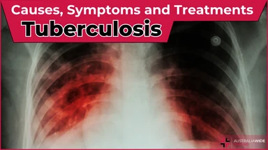 Tuberculosis article header – First Aid Article in Hunter Region